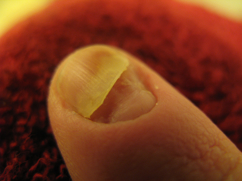 fingernail split #11
